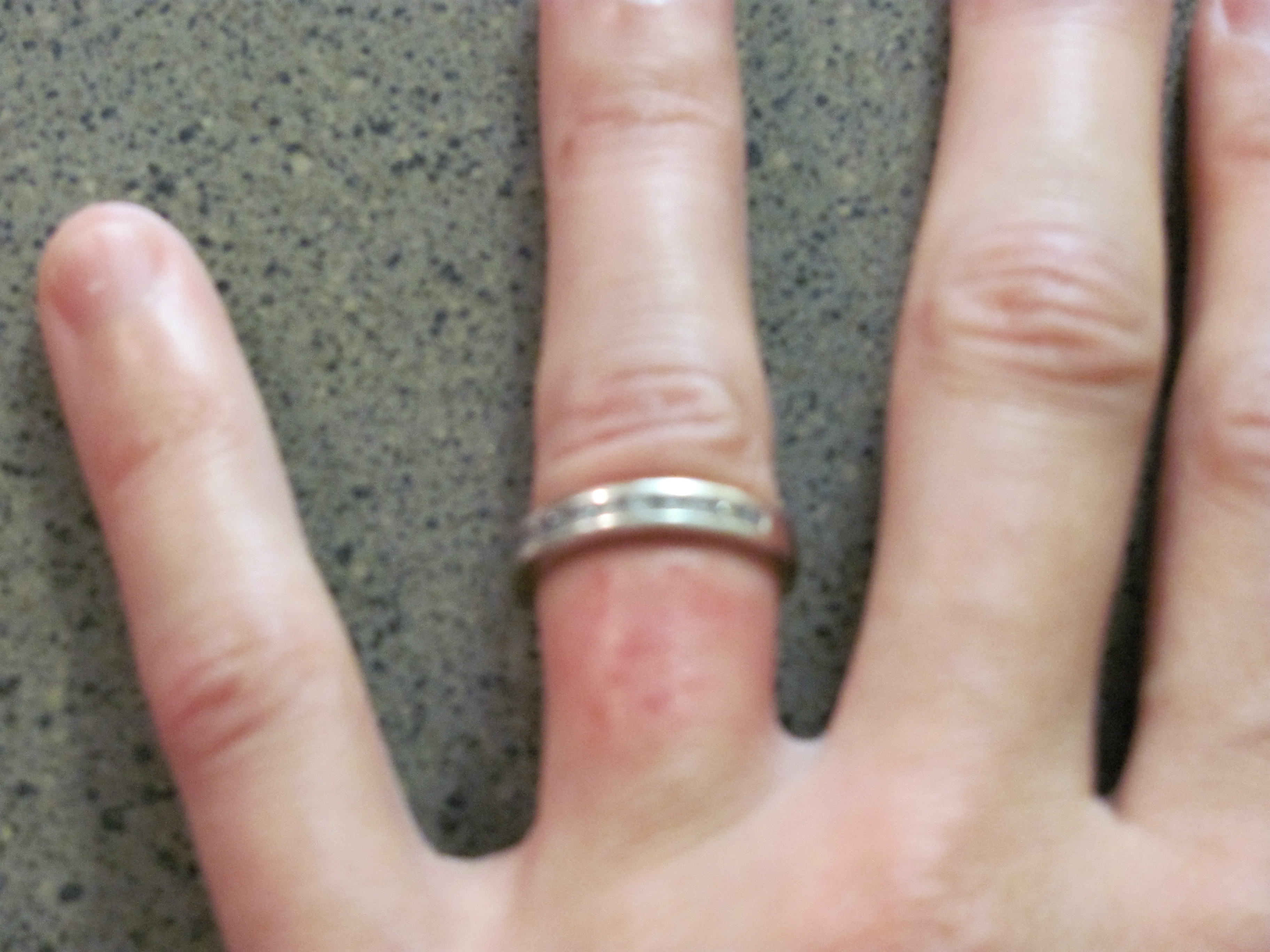 wedding ring makes my finger itch